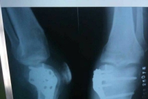 关于膝关节术后活动度，求帮助