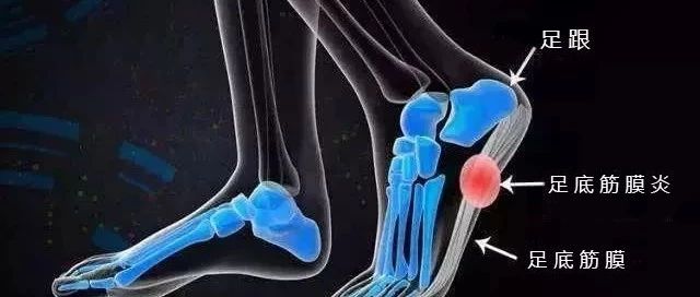 足跟痛:康复师教你这几招,可以缓解90%的足跟痛