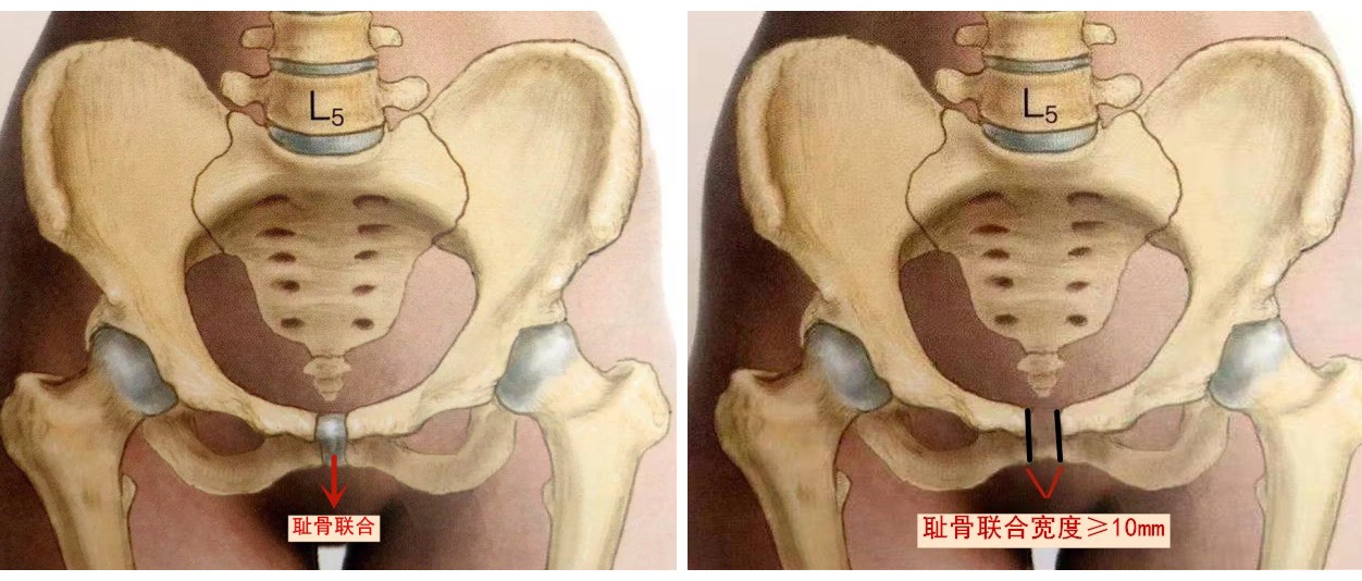 痛到怀疑人生,产后耻骨联合分离该如何防治