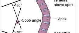 一篇好文带你剥开脊柱侧弯(scoliosis)的层层面纱(PartI)