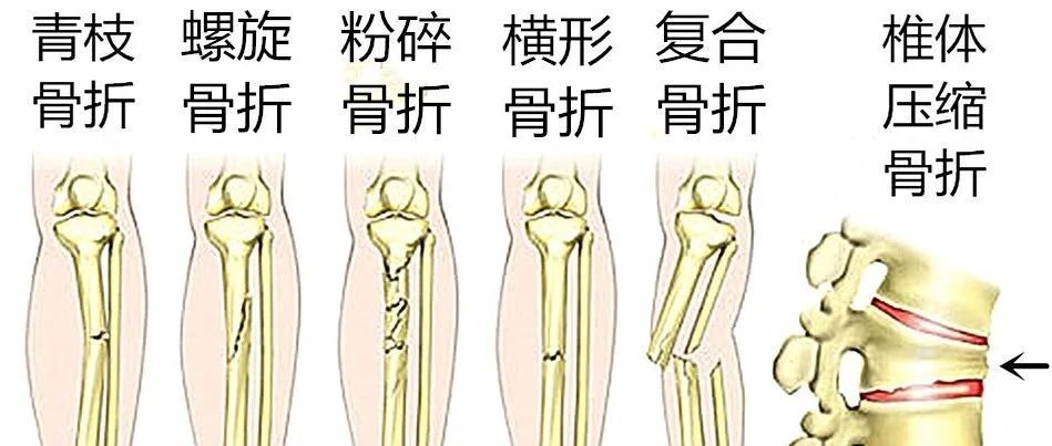 图解骨折分类和常见骨折类型