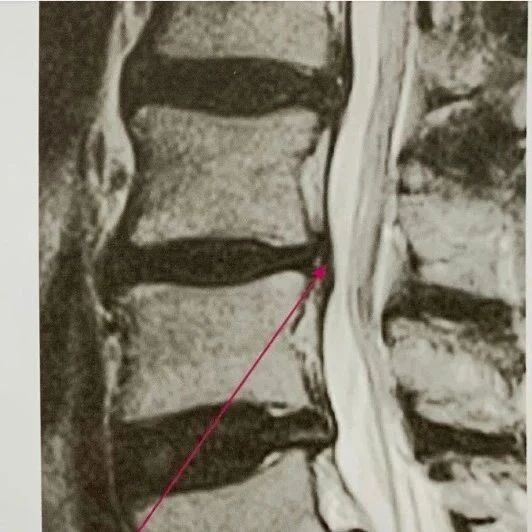 腰间盘突出案例分享和动作讲解