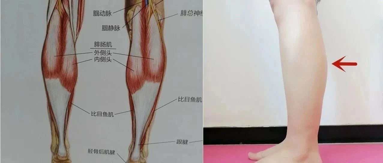 步态异常,足跟痛皆因小腿三头肌紧张?4步教你精准拉伸