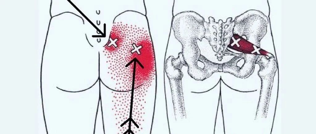 梨状肌扳机点的综合处理:改善臀腿痛&坐骨神经痛