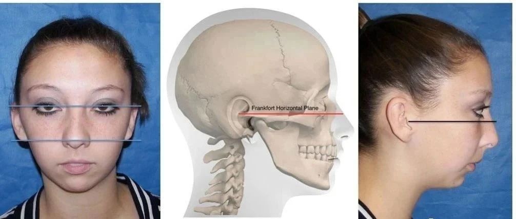 颅面评估必知概念:法兰克福平面(FHP)