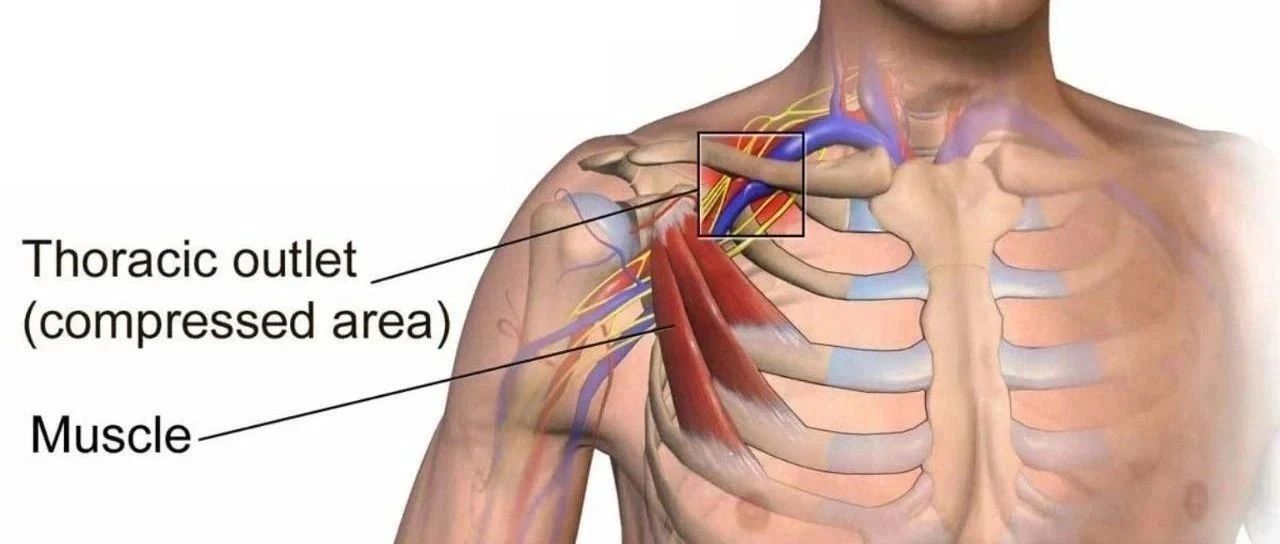 PT临床常见诊断:胸廓出口综合征(TOS)