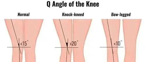 膝前部疼痛与Q角度:一些常用的练习方法.