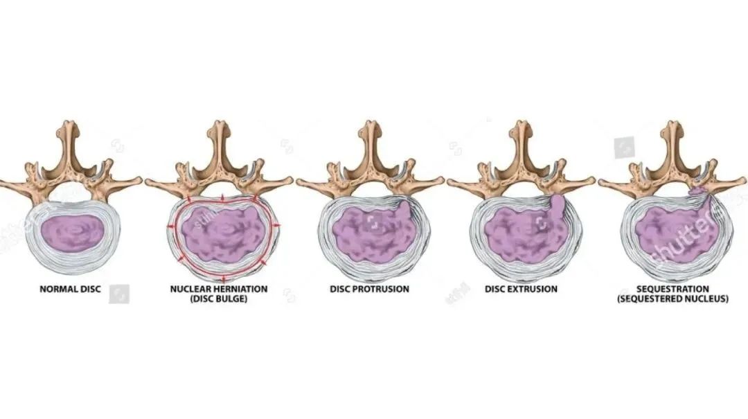 椎间盘突出,是事实还是恐吓?