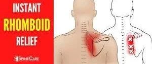 菱形肌激痛点:肩胛骨之间挥之不去的疼痛.