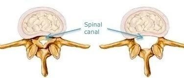 「间歇性跛行」不一定是椎管狭窄,这3种原因要分清!
