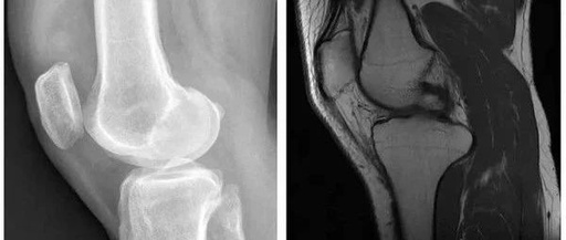 膝盖疼髌骨软化,教你正确的处理方式